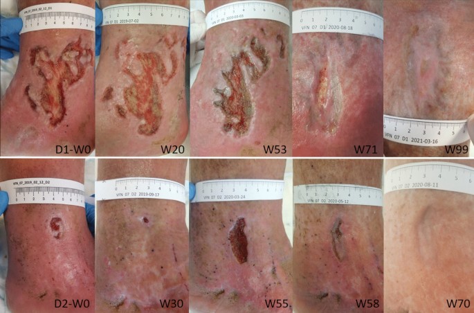 استفاده از مشتقات غشای آمنیوتیک برای درمان زخم‌های مزمن