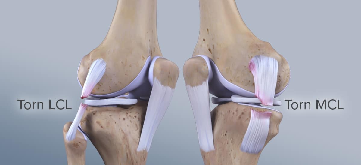 بازسازی رباط صلیبی قدامی با پرده آمنیوتیک